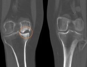 Artrosis de la rodilla derecha