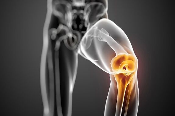 Artrosis de la articulación de la rodilla