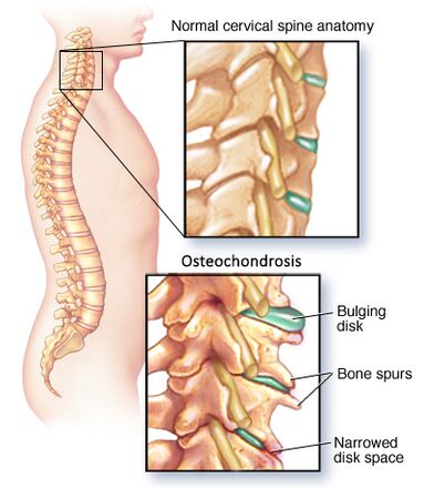 osteocondrosis cervical