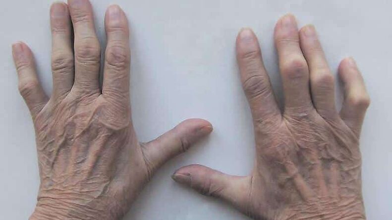 Métodos para tratar el dolor en las articulaciones de los dedos