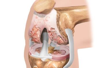 Artrosis de la articulación de la rodilla