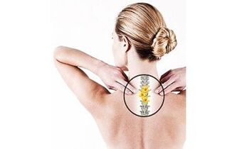 osteocondrosis cervical en una mujer