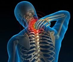 osteocondrosis de la columna cervical