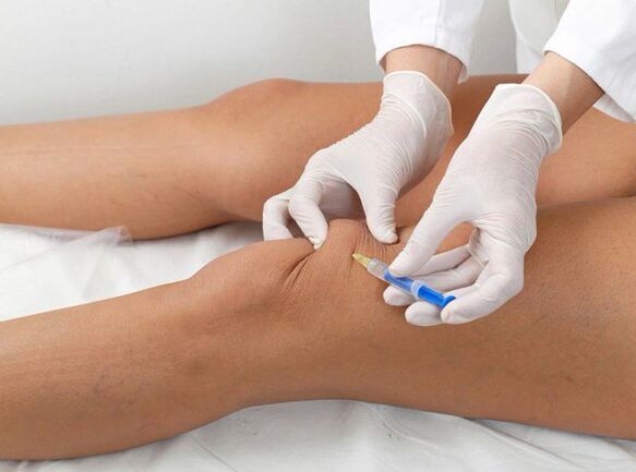 Inyección intraarticular para artrosis de rodilla.