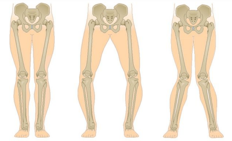 complicaciones de la artrosis de rodilla