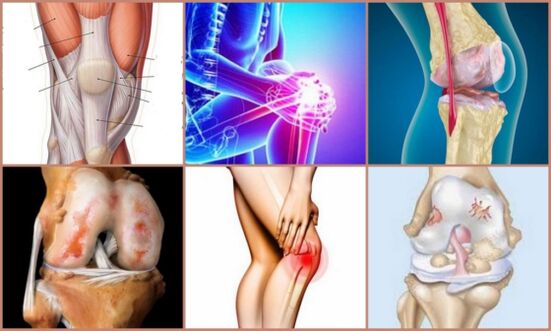 desarrollo de artrosis de rodilla