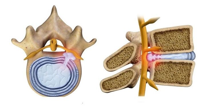 Hernia de disco intervertebral protrusión del núcleo del disco hacia el canal espinal